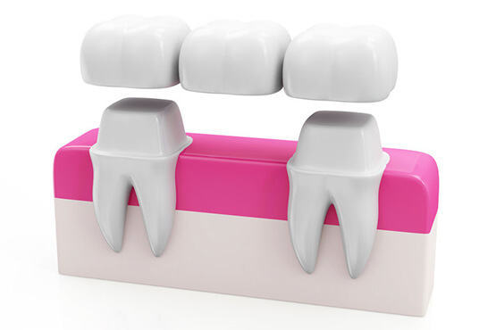 Dental Bridge