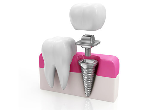 Dental Implant