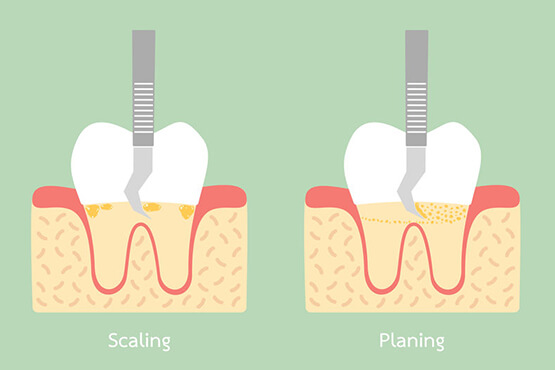 Scaling and Root Planing